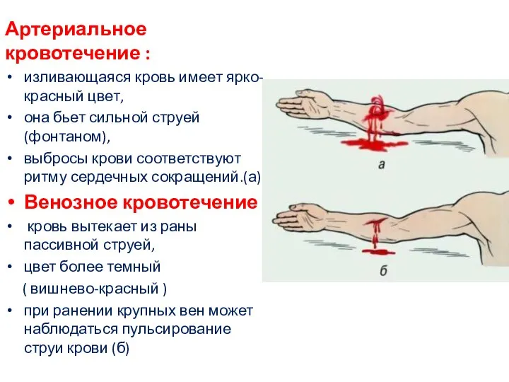 Артериальное кровотечение : изливающаяся кровь имеет ярко-красный цвет, она бьет сильной