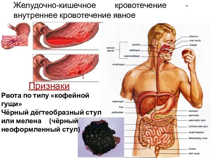 Желудочно-кишечное кровотечение - внутреннее кровотечение явное Признаки Рвота по типу «кофейной