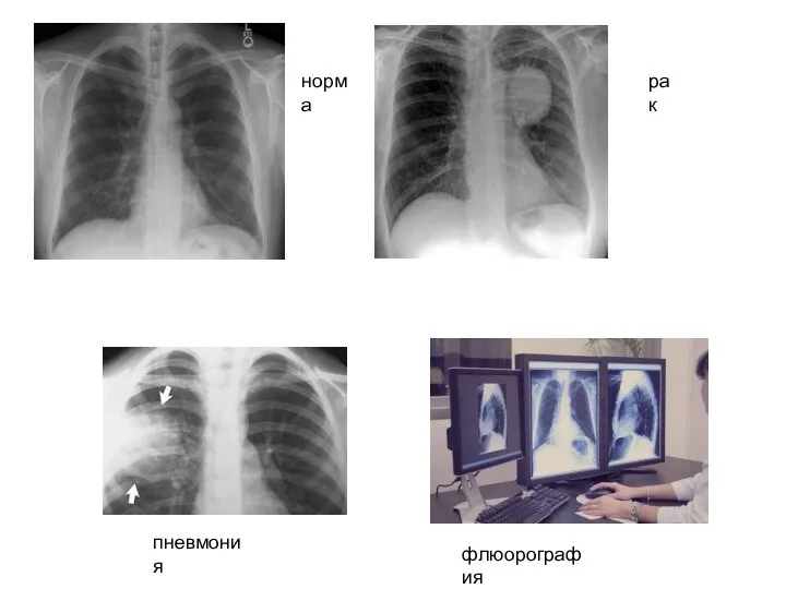 норма рак пневмония флюорография