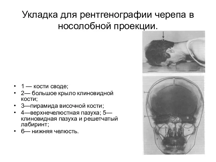 Укладка для рентгенографии черепа в носолобной проекции. 1 — кости своде;