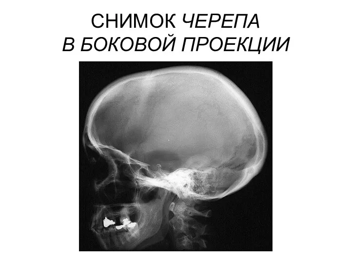 СНИМОК ЧЕРЕПА В БОКОВОЙ ПРОЕКЦИИ