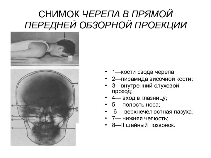 СНИМОК ЧЕРЕПА В ПРЯМОЙ ПЕРЕДНЕЙ ОБЗОРНОЙ ПРОЕКЦИИ 1—кости свода черепа; 2—пирамида