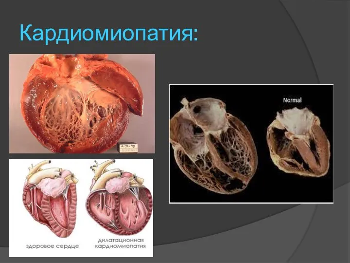 Кардиомиопатия: