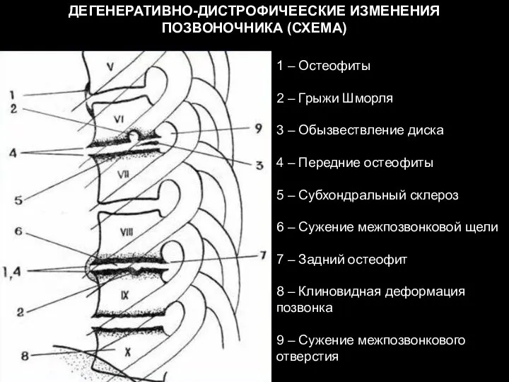 ДЕГЕНЕРАТИВНО-ДИСТРОФИЧЕЕСКИЕ ИЗМЕНЕНИЯ ПОЗВОНОЧНИКА (СХЕМА) 1 – Остеофиты 2 – Грыжи Шморля