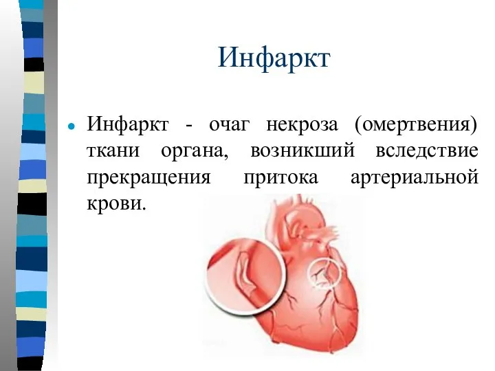Инфаркт Инфаркт - очаг некроза (омертвения) ткани органа, возникший вследствие прекращения притока артериальной крови.
