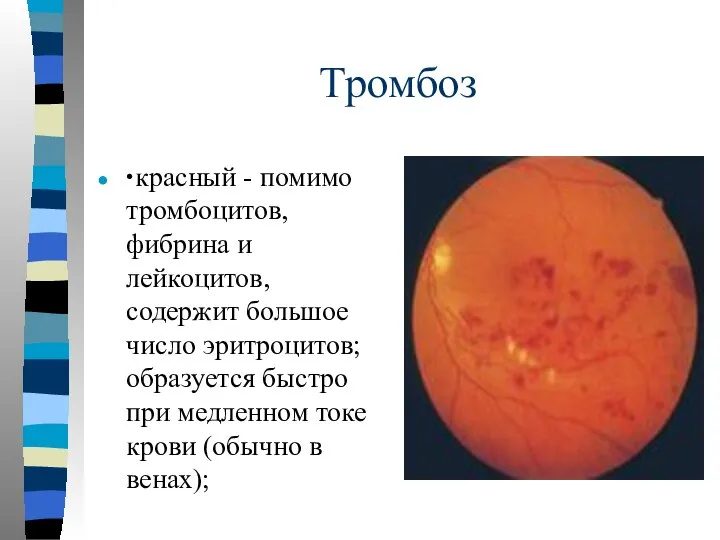 Тромбоз ∙ красный - помимо тромбоцитов, фибрина и лейкоцитов, содержит большое