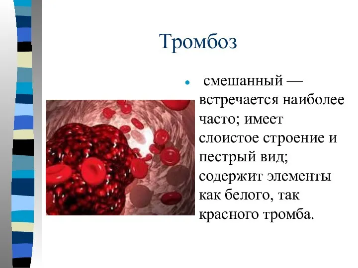 Тромбоз смешанный — встречается наиболее часто; имеет слоистое строение и пестрый