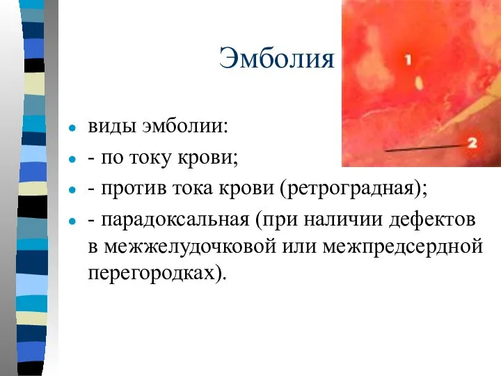 Эмболия виды эмболии: - по току крови; - против тока крови