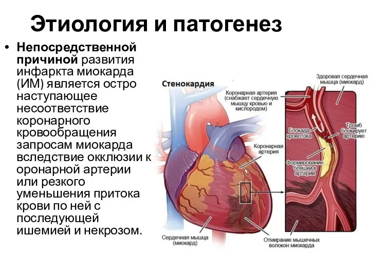 Этиология и патогенез Непосредственной причиной развития инфаркта миокарда (ИМ) является остро