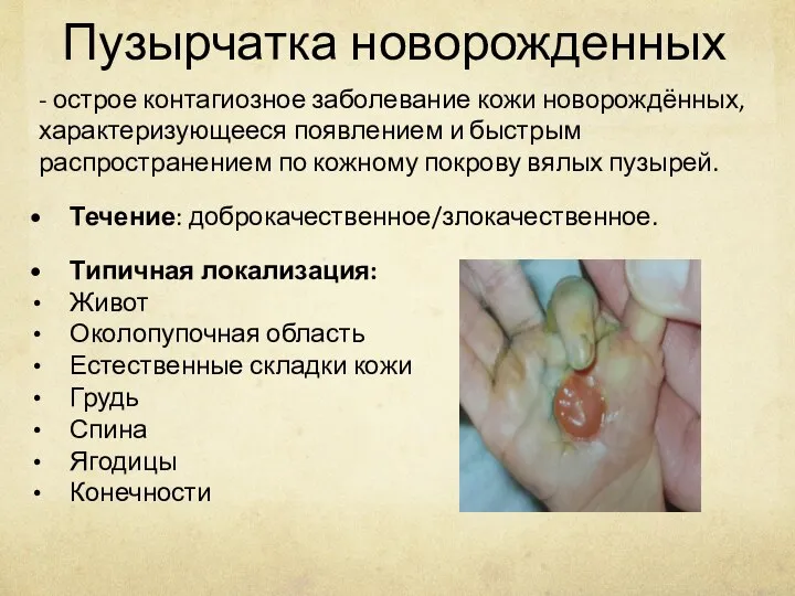 Пузырчатка новорожденных - острое контагиозное заболевание кожи новорождённых, характеризующееся появлением и