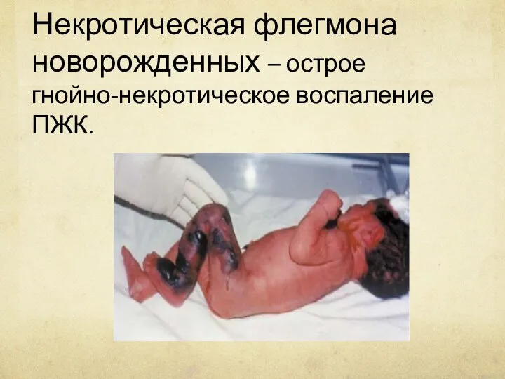 Некротическая флегмона новорожденных – острое гнойно-некротическое воспаление ПЖК.