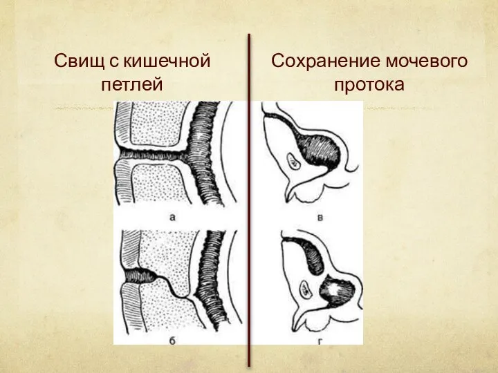 Свищ с кишечной петлей Сохранение мочевого протока