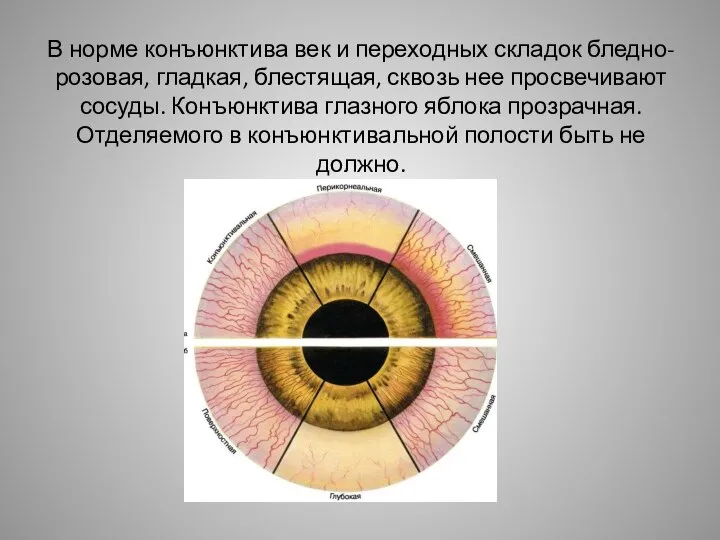 В норме конъюнктива век и переходных складок бледно-розовая, гладкая, блестящая, сквозь