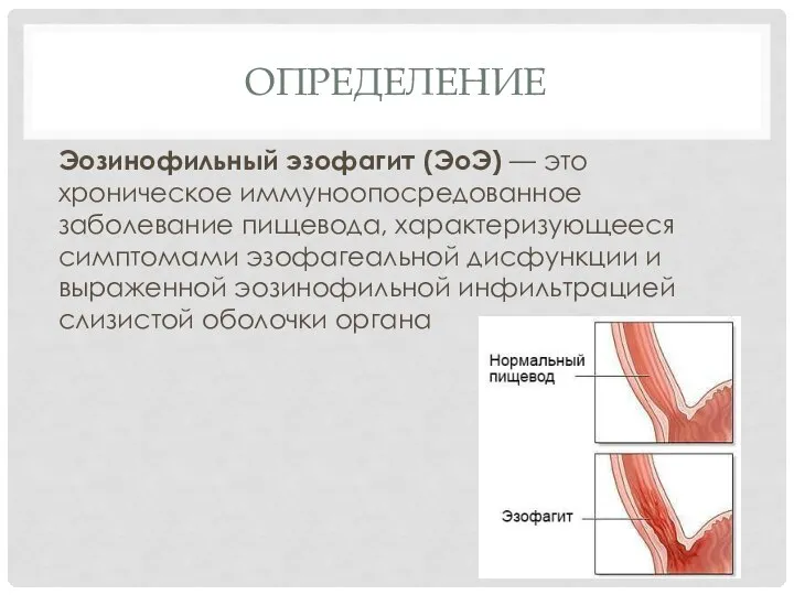 ОПРЕДЕЛЕНИЕ Эозинофильный эзофагит (ЭоЭ) — это хроническое иммуноопосредованное заболевание пищевода, характеризующееся