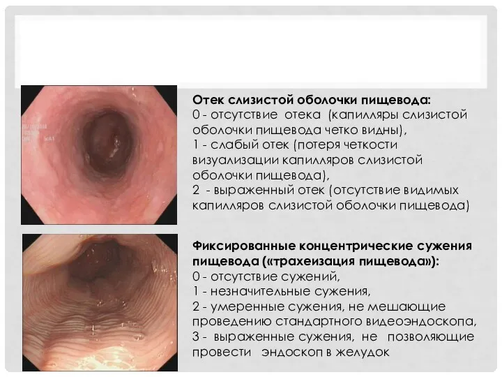 Отек слизистой оболочки пищевода: 0 - отсутствие отека (капилляры слизистой оболочки