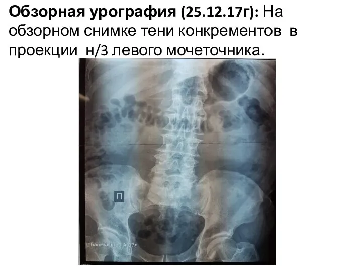 Обзорная урография (25.12.17г): На обзорном снимке тени конкрементов в проекции н/3 левого мочеточника.