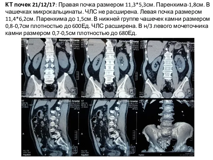 КТ почек 21/12/17: Правая почка размером 11,3*5,3см. Паренхима-1,8см. В чашечках микрокальцинаты.