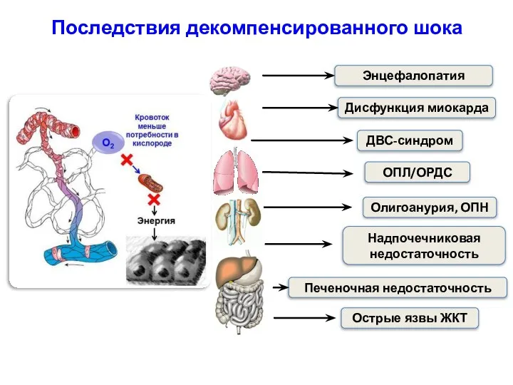 Последствия декомпенсированного шока Энцефалопатия ОПЛ/ОРДС Дисфункция миокарда ДВС-синдром Печеночная недостаточность Олигоанурия,