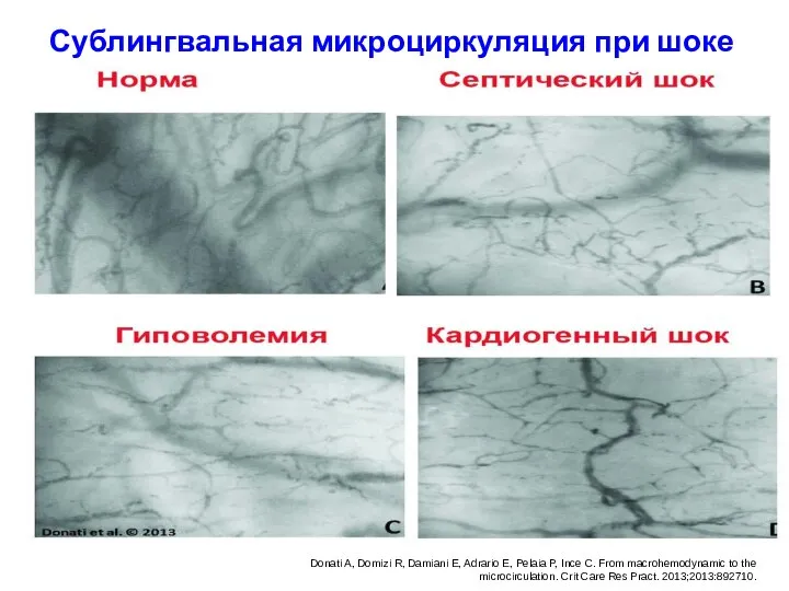 Сублингвальная микроциркуляция при шоке Donati A, Domizi R, Damiani E, Adrario