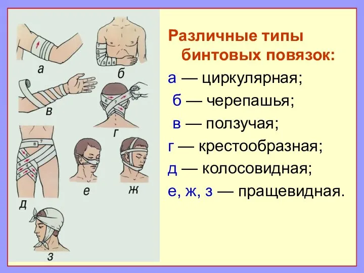 Различные типы бинтовых повязок: а — циркулярная; б — черепашья; в