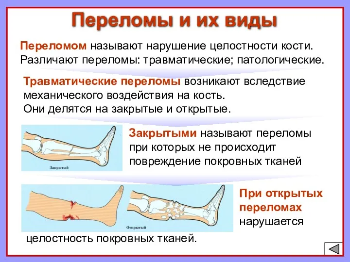 Переломы и их виды При открытых переломах нарушается Переломом называют нарушение