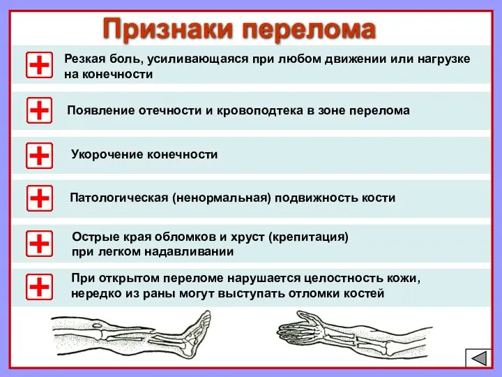 Признаки перелома Резкая боль, усиливающаяся при любом движении или нагрузке на