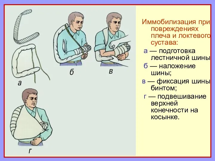 Иммобилизация при повреждениях плеча и локтевого сустава: а — подготовка лестничной