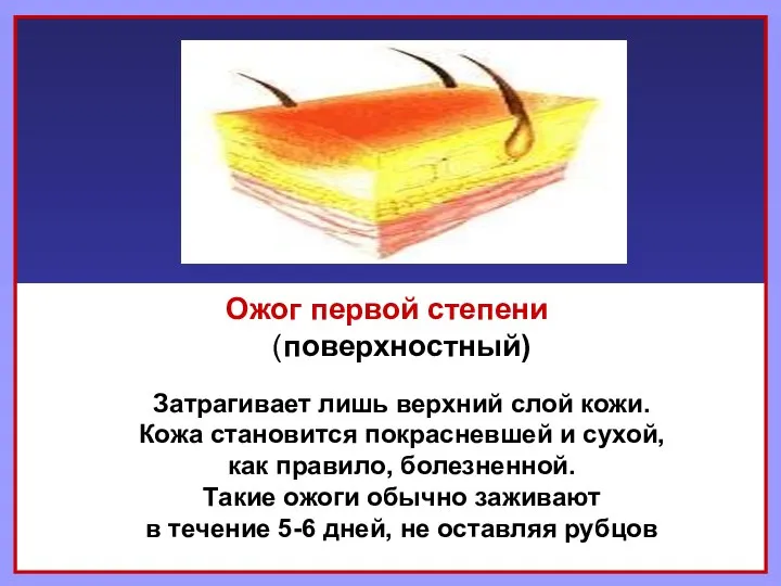 Ожог первой степени (поверхностный) Затрагивает лишь верхний слой кожи. Кожа становится