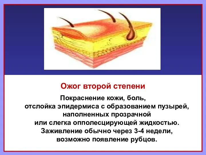 Ожог второй степени Покраснение кожи, боль, отслойка эпидермиса с образованием пузырей,