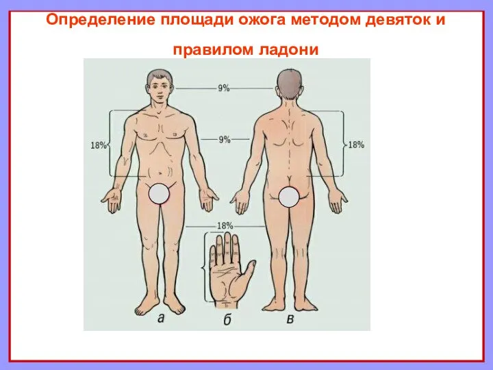 Определение площади ожога методом девяток и правилом ладони