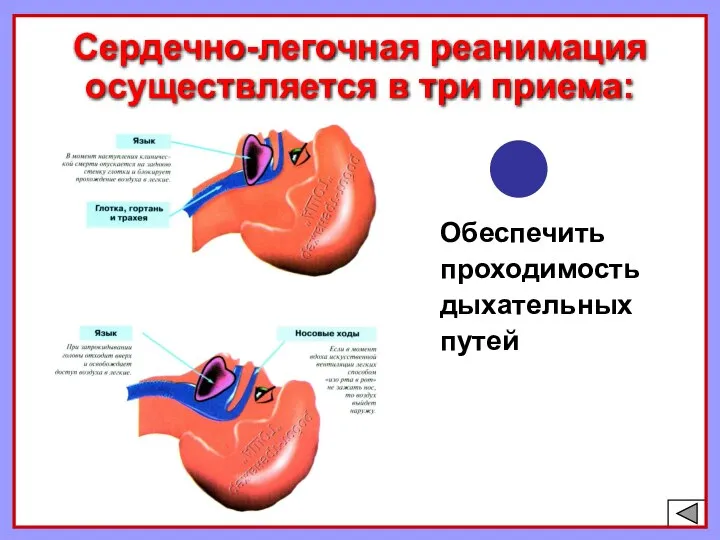 Сердечно-легочная реанимация осуществляется в три приема: Обеспечить проходимость дыхательных путей