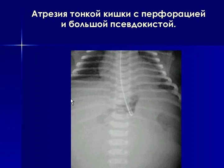 Атрезия тонкой кишки с перфорацией и большой псевдокистой.