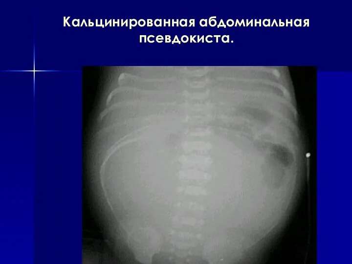 Кальцинированная абдоминальная псевдокиста.