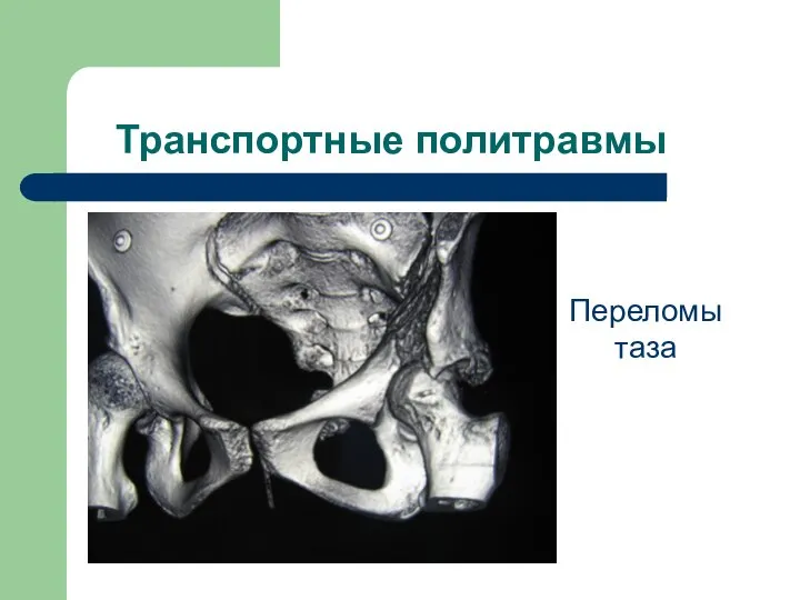 Транспортные политравмы Переломы таза