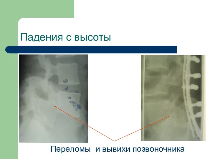 Падения с высоты Переломы и вывихи позвоночника