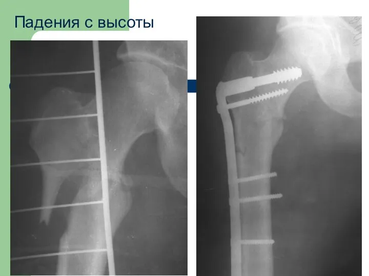 Падения с высоты