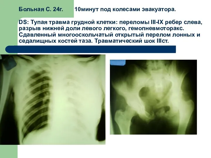 Больная С. 24г. 10минут под колесами эвакуатора. DS: Тупая травма грудной