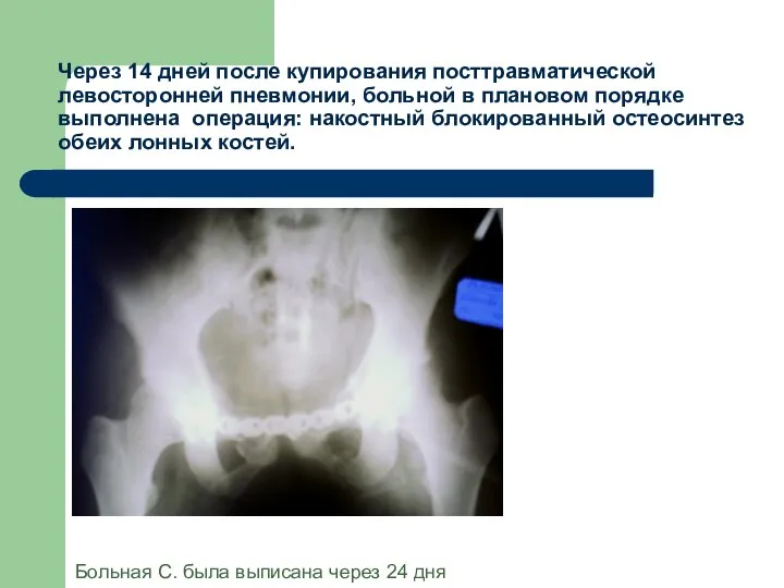 Через 14 дней после купирования посттравматической левосторонней пневмонии, больной в плановом