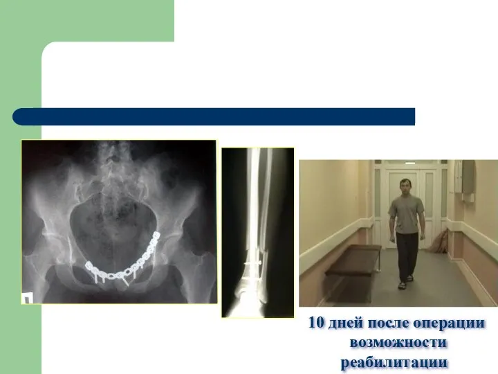 10 дней после операции возможности реабилитации