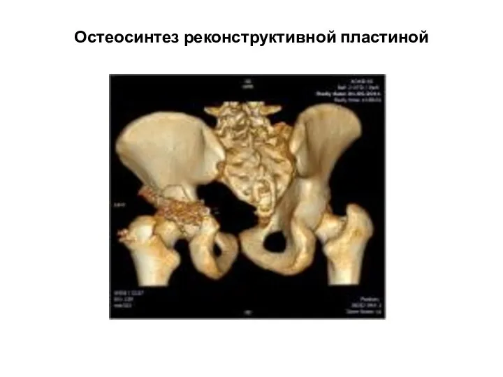 Остеосинтез реконструктивной пластиной