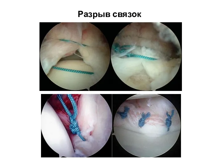 Разрыв связок