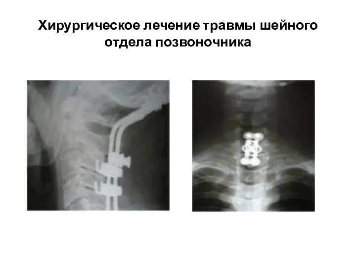 Хирургическое лечение травмы шейного отдела позвоночника