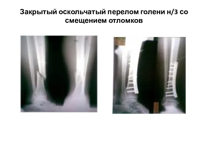 Закрытый оскольчатый перелом голени н/3 со смещением отломков