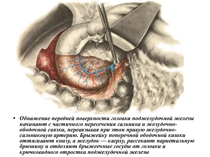 Обнажение передней поверхности головки поджелудочной железы начинают с частичного пересечения сальника