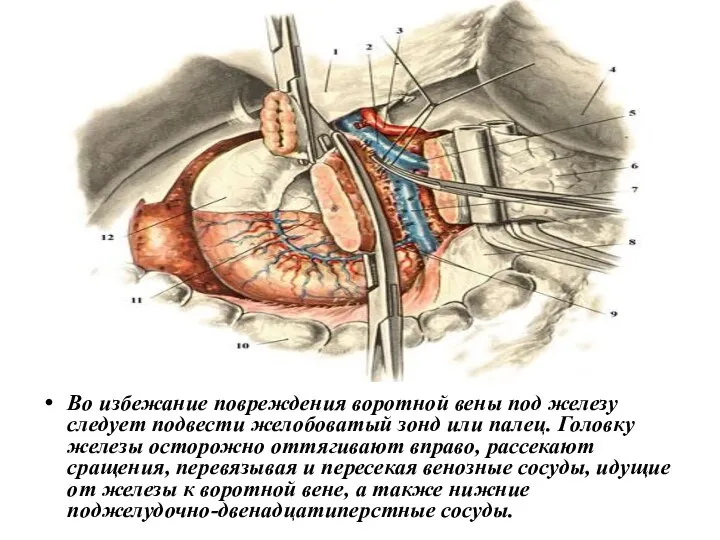 Во избежание повреждения воротной вены под железу следует подвести желобоватый зонд