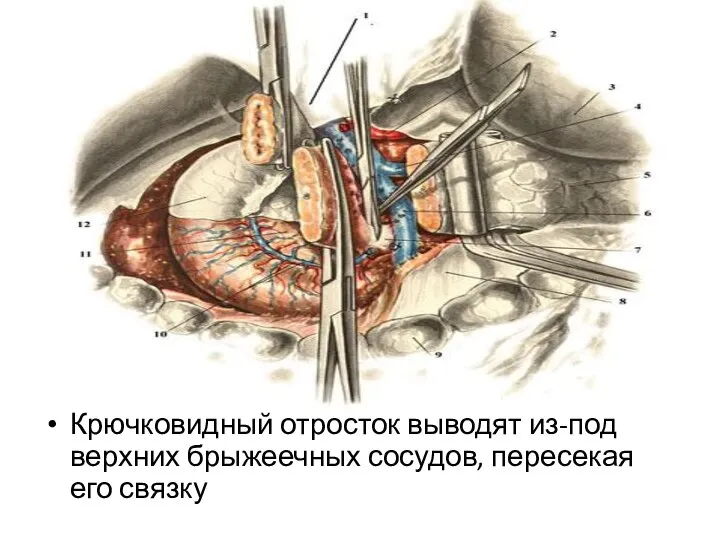 Крючковидный отросток выводят из-под верхних брыжеечных сосудов, пересекая его связку