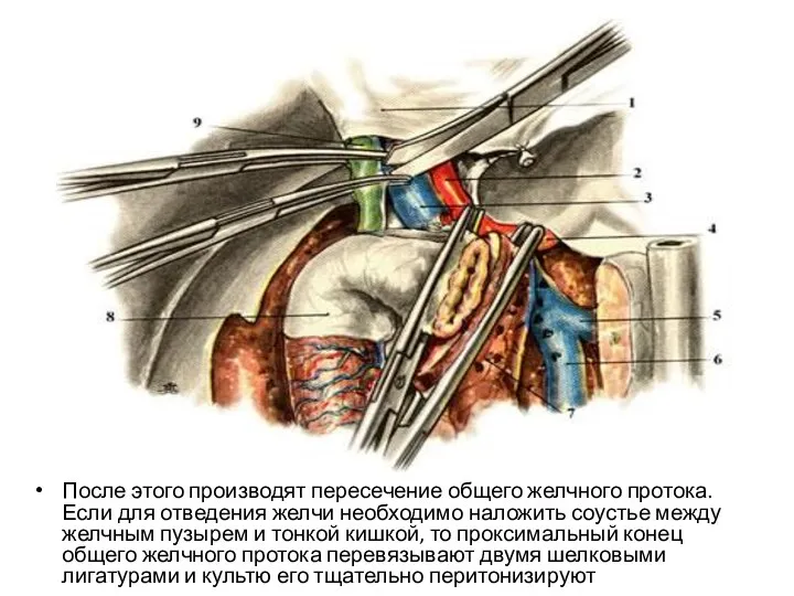 После этого производят пересечение общего желчного протока. Если для отведения желчи