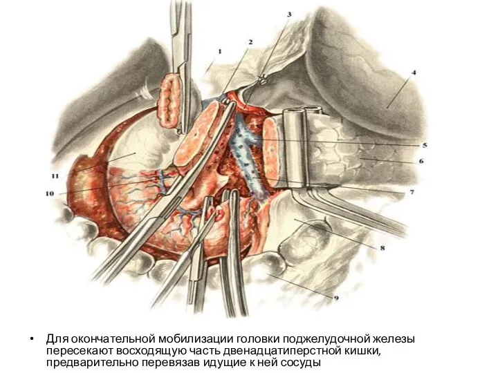Для окончательной мобилизации головки поджелудочной железы пересекают восходящую часть двенадцатиперстной кишки,