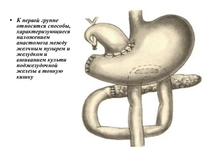 К первой группе относятся способы, характеризующиеся наложением анастомоза между желчным пузырем