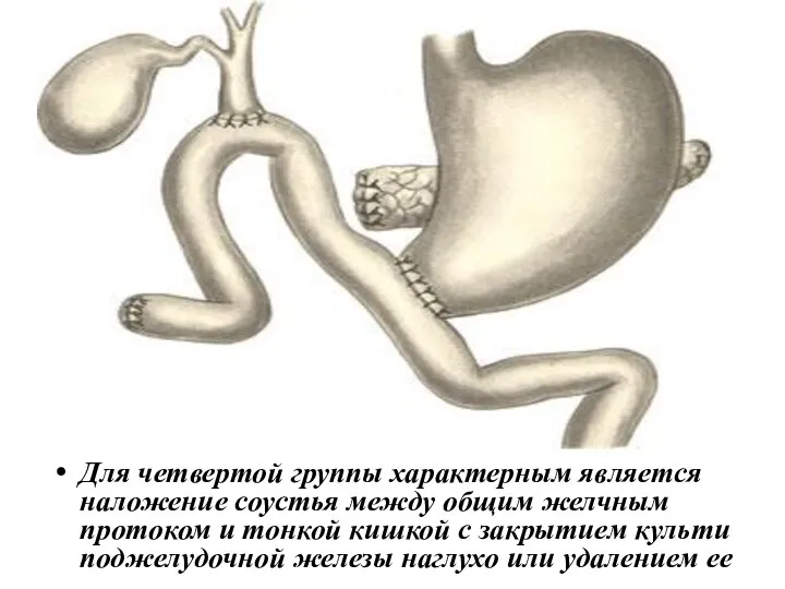 Для четвертой группы характерным является наложение соустья между общим желчным протоком